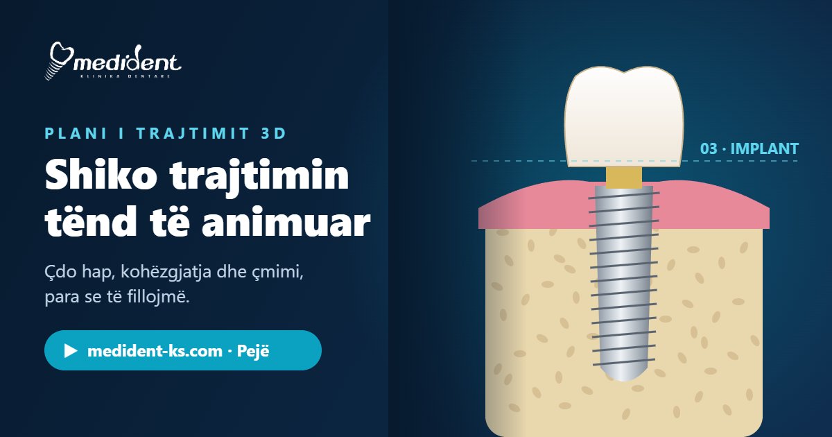 Animacion 3D i vendosjes së implantit dentar në planin e trajtimit të Medident