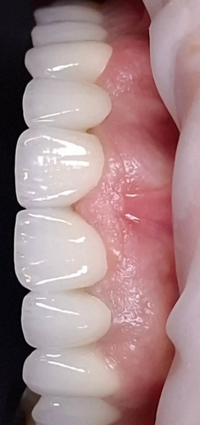 After zirconia crowns