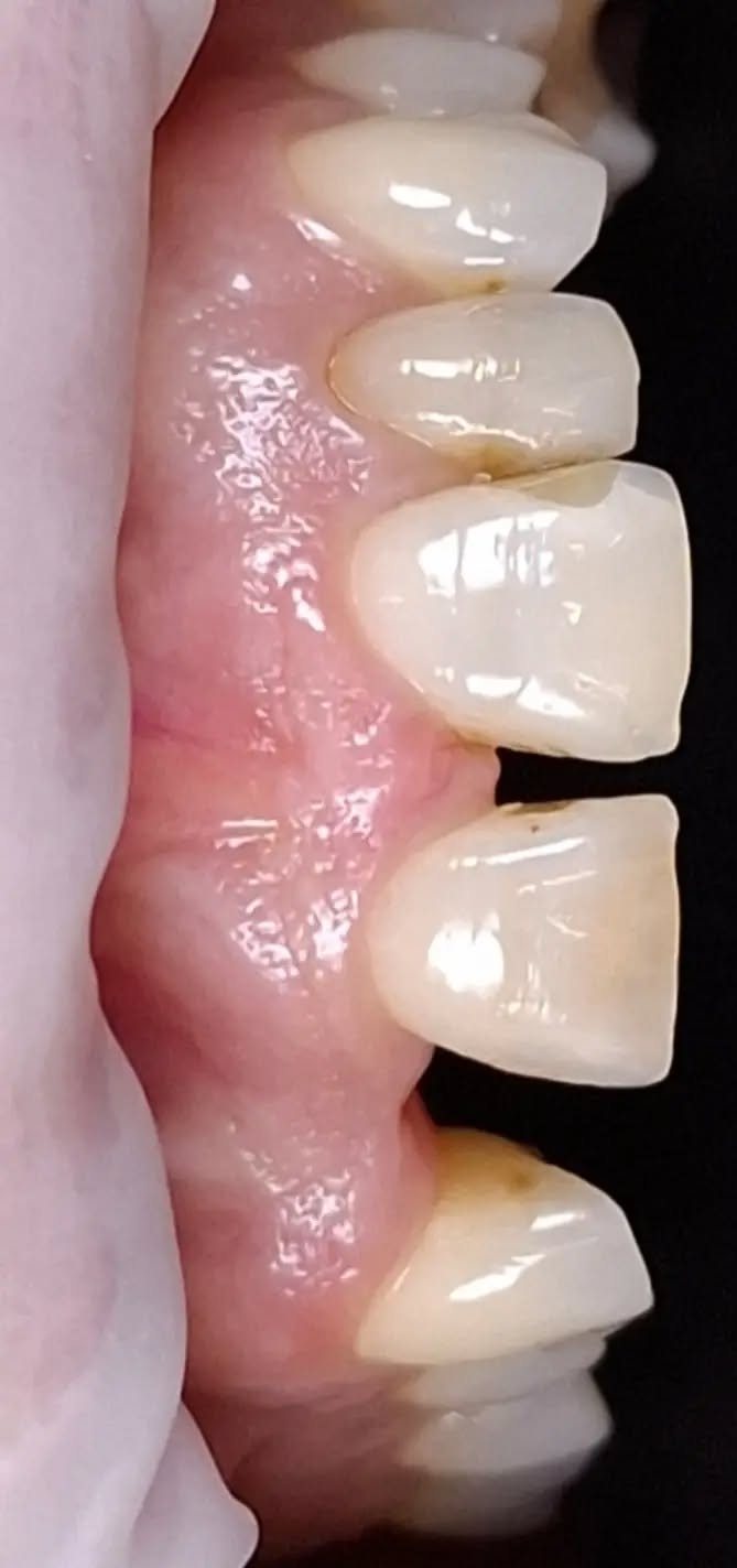 Before zirconia crowns