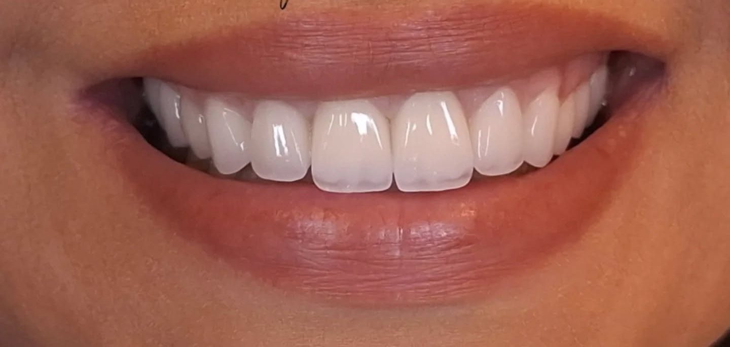 Smile after