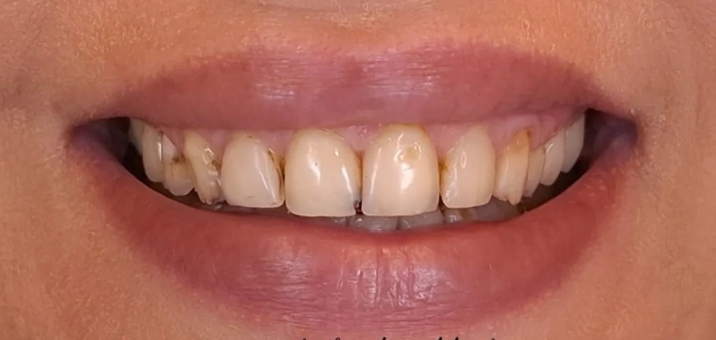 Smile before