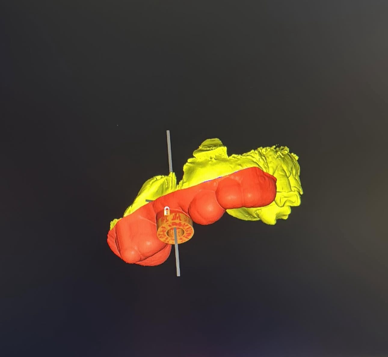 3D implant plan