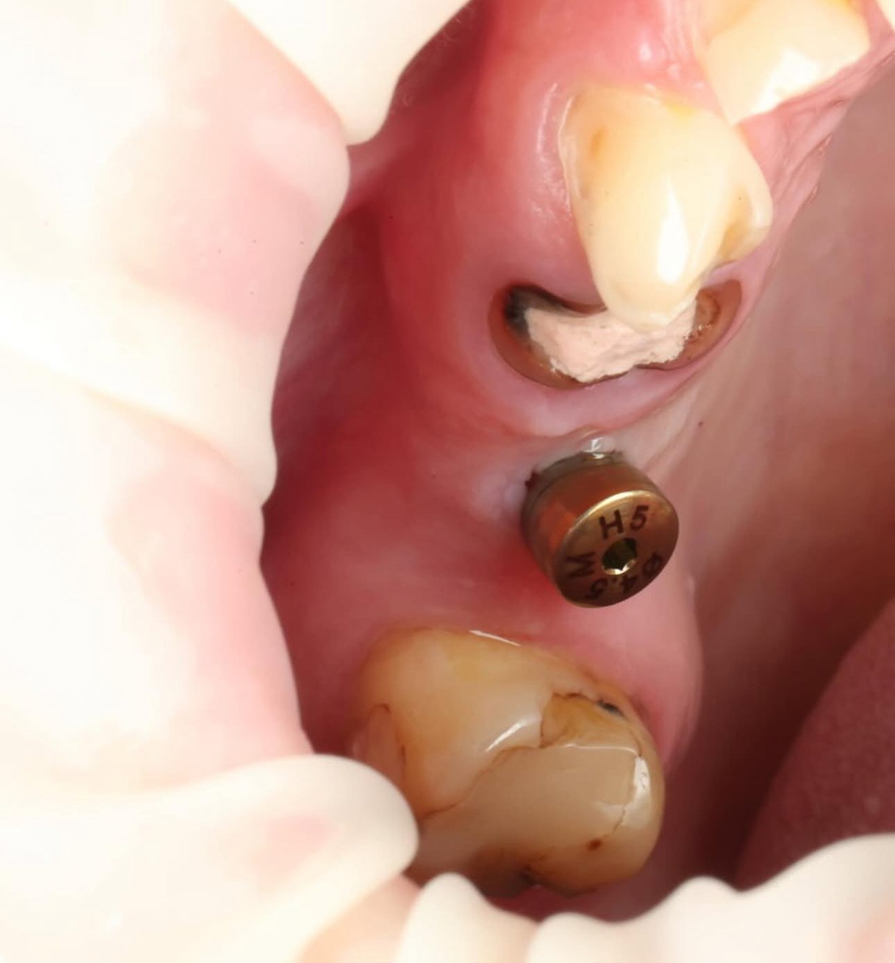 Implant placed
